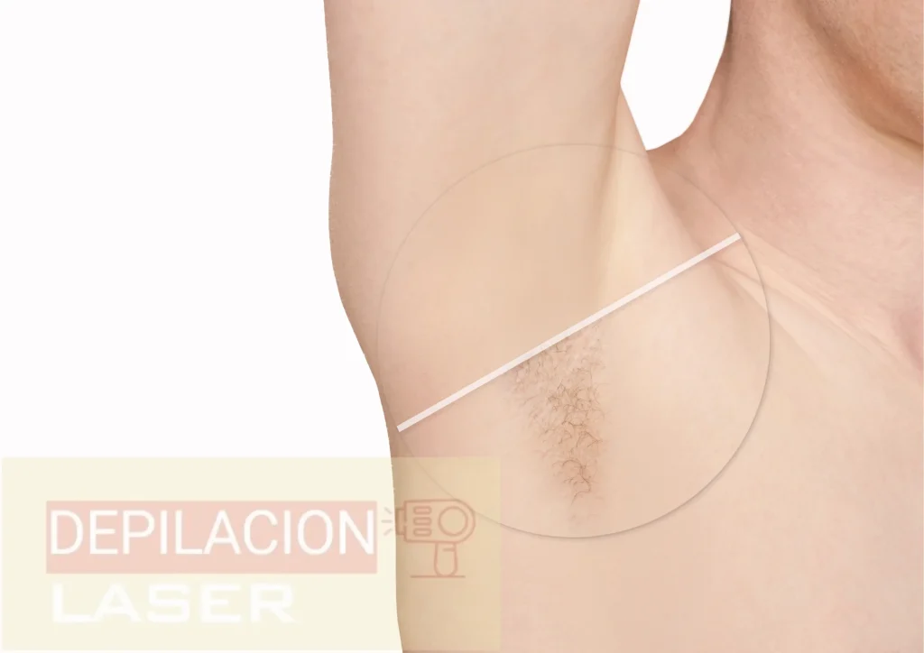 depilacion laser antes y despues